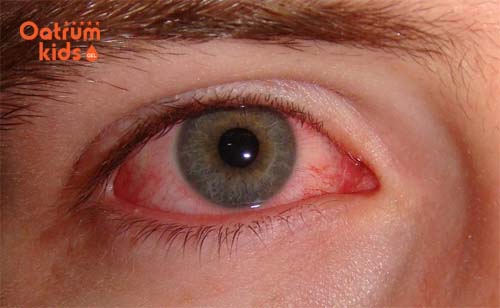 Cách chữa đau mắt bằng thuốc nam mà bạn có thể áp dụng tại nhà.