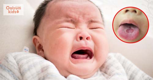 Cách chữa tưa lưỡi bằng Natri Bicarbonat cho trẻ hiệu quả