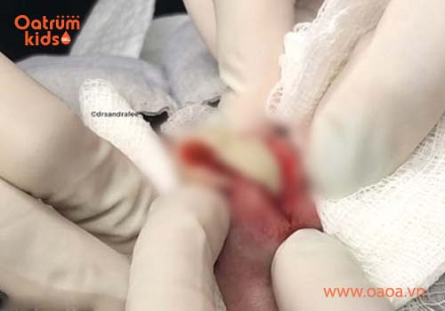 Cách hút mủ mụn nhọt cho bé tại nhà