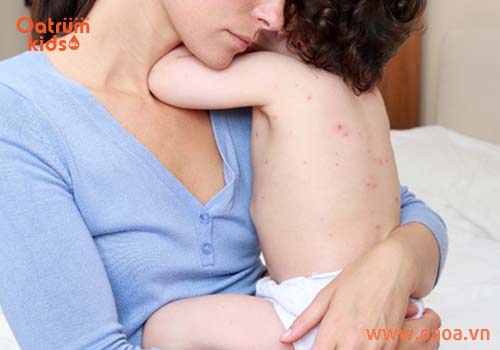 Cách trị mụn nhọt đơn giản cho bé mẹ đã biết chưa?