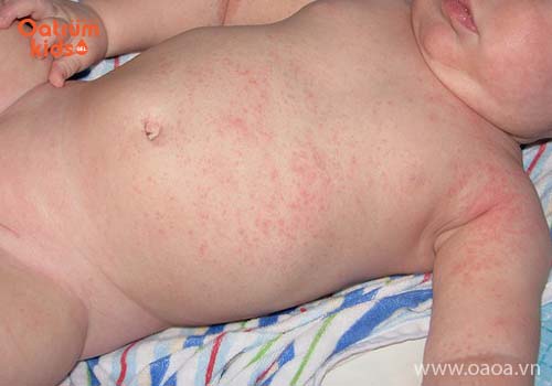 Cách trị rôm sảy cho trẻ sơ sinh hiệu quả sau 2-3 ngày