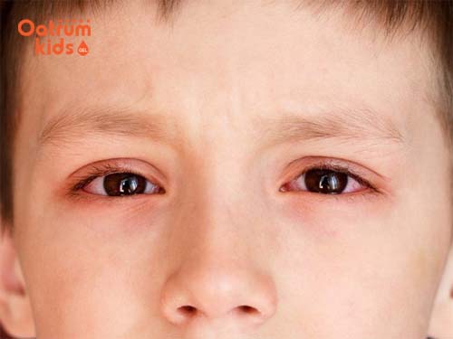 Cần tìm hiểu gì về bệnh đau mắt đỏ ở trẻ em