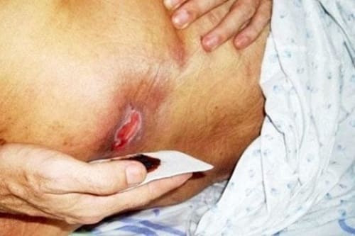 Cảnh báo: Những biến chứng ở người phải nằm lâu một chỗ