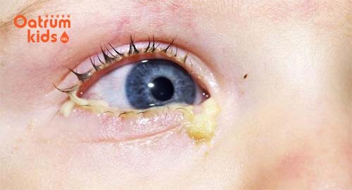 Cha mẹ cần làm gì khi bé 2 tuổi mắt bị đổ ghèn?