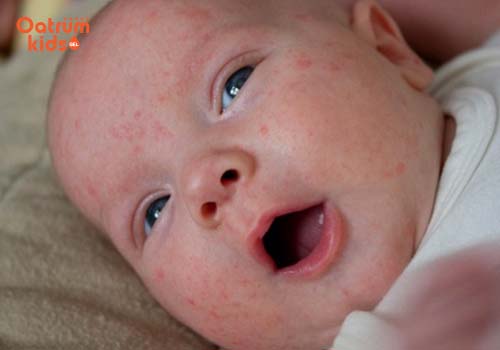 Cha mẹ “sốt vó” khi bé bị rôm sảy ở mặt