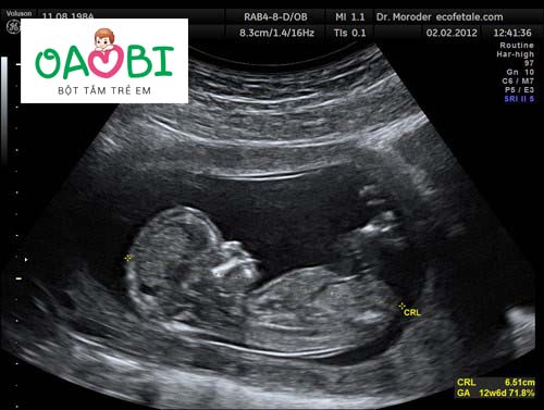 Chiều dài xương mũi thai nhi chuẩn theo tuần mẹ nên biết?