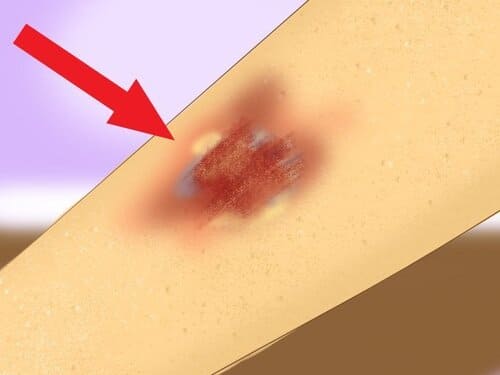 Dấu hiệu vết thương bị hoại tử và cách chữa kịp thời