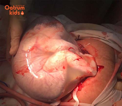 Đẻ bọc điều và những điều bác sĩ muốn mẹ biết càng sớm càng tốt