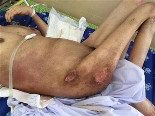 Điểm danh các loại thuốc trị hoại tử cho người già