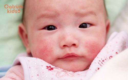 Giải đáp thắc mắc: Chàm sữa có để lại sẹo không?