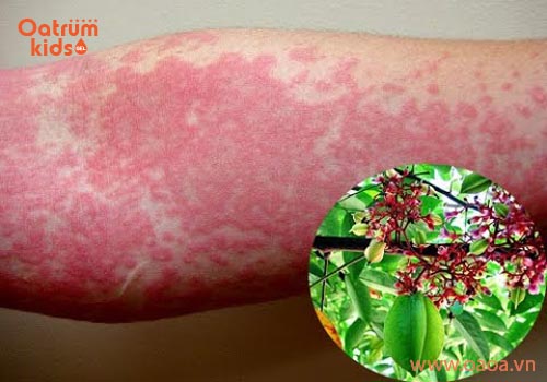 Giải mã thắc mắc bệnh nổi mề đay có nguy hiểm không?