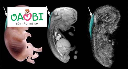 Khoảng sáng sau gáy bao nhiêu là bình thường?
