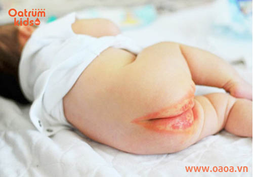 Kinh nghiệm trị hăm tã cho bé bằng lá trầu không