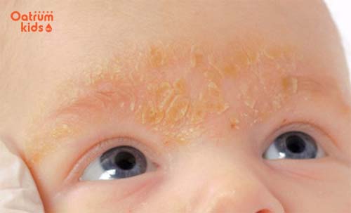 Lông mày trẻ sơ sinh có vảy có phải là dấu hiệu bệnh nguy hiểm?