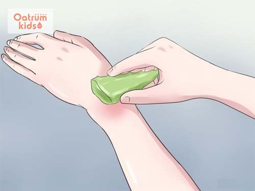 Mách bạn 6 bài thuốc trị bỏng nước sôi tại nhà theo kinh nghiệm dân gian