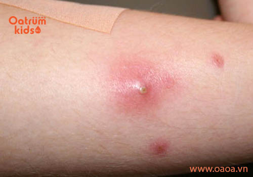 Mách mẹ cách trị mụn sưng đỏ dứt điểm ở trẻ