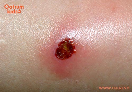 Mách mẹ cách xử lý vết thương trầy xước chảy nước ở trẻ