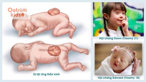 Mẹ đã biết những thông tin cơ bản về hội chứng Edwards ở trẻ?