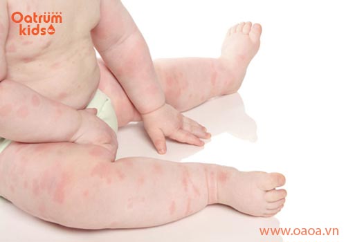 Mẹ Việt hoảng hốt khi bé bị nổi mề đay khắp người