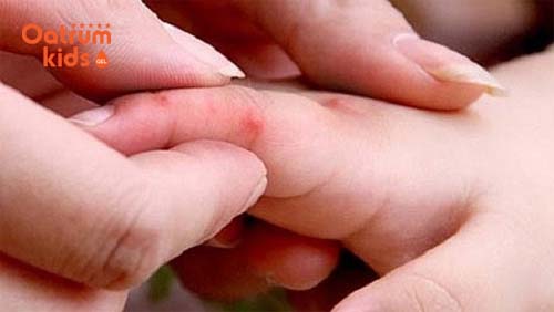 Nguyên nhân bệnh tay chân miệng bạn cần biết