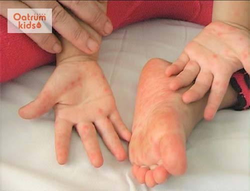 Nguyên nhân, triệu chứng và cách điều trị bệnh tay chân miệng ở trẻ em