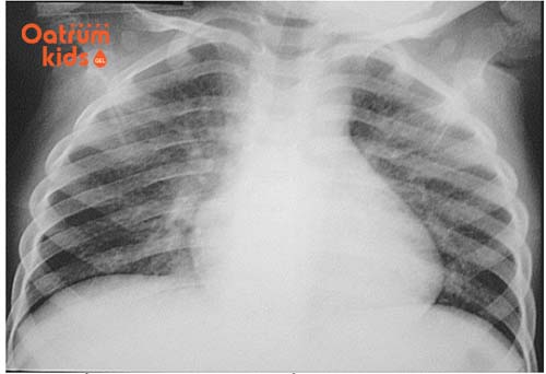 Nhận biết dấu hiệu bệnh sởi ở trẻ dưới 1 tuổi để phòng tránh biến chứng