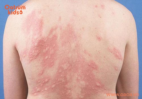 Nhận biết triệu chứng nổi mề đay ở trẻ