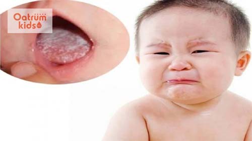 Nhận diện “thủ phạm” khiến trẻ bị tưa lưỡi và cách điều trị hiệu quả