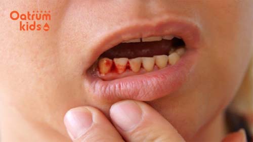 Những biện pháp điều trị khi trẻ bị chảy máu chân răng cha mẹ cần biết