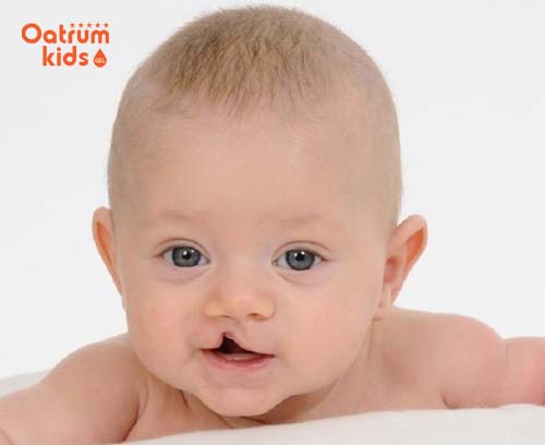 Những điều cần biết khi trẻ bị sứt môi lúc mới sinh ra