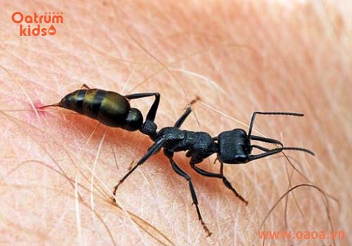 Những điều mẹ cần biết khi trẻ bị côn trùng cắn
