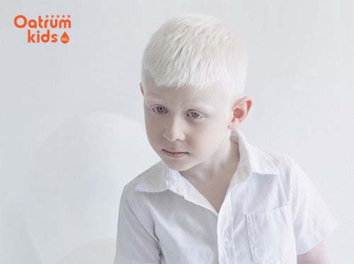 Những thông tin cơ bản về bệnh bạch biến ở trẻ em