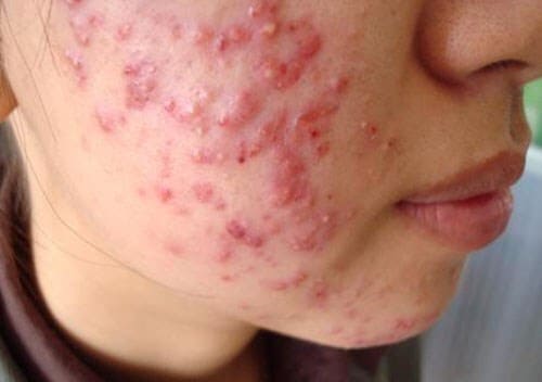 Nổi mụn mủ ở mặt áp dụng ngay 3 cách chữa “thần thánh” này