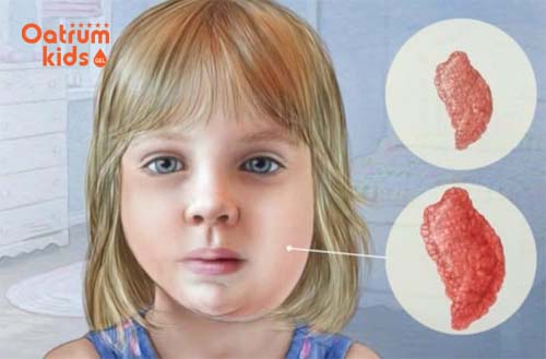 Quai bị ở trẻ em: Nguyên nhân, triệu chứng và phương pháp điều trị