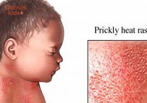 Rôm sảy là gì? Làm sao để điều trị khỏi sau 3-5 ngày?