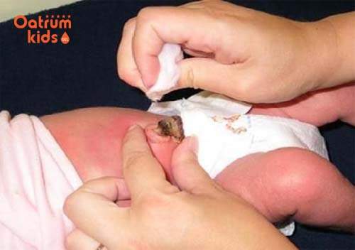 Rốn trẻ sơ sinh có mùi hôi: Mẹ cần làm gì?