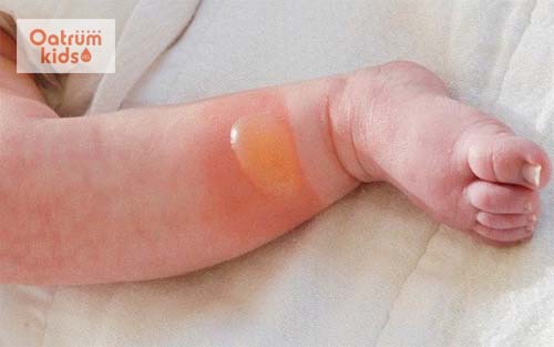 Sơ cứu bỏng nước cho trẻ đúng cách