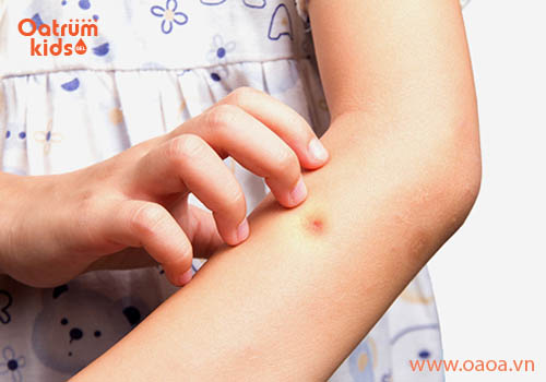 Tại sao muỗi đốt lại ngứa ngáy?