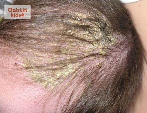 Tất tần tật những điều mẹ nên biết về hiện tượng cứt trâu ở trẻ sơ sinh