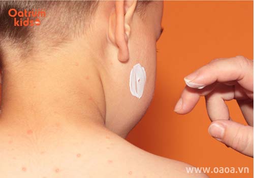 Thuốc bôi côn trùng cắn hiệu quả cho bé