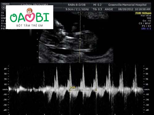 Tiết lộ chính xác thai mấy tuần thì có tim thai?