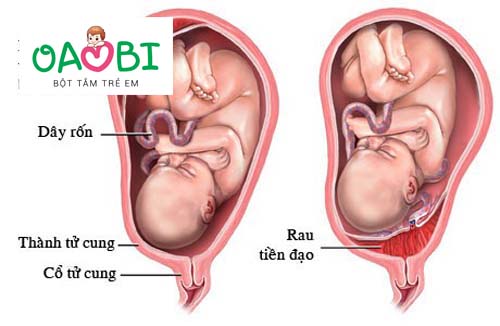 Tìm hiểu hiện tượng nhau cài răng lược là gì?