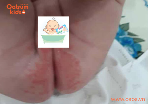 Trẻ bị hăm háng và cách trị hăm háng ở trẻ sau 3 ngày