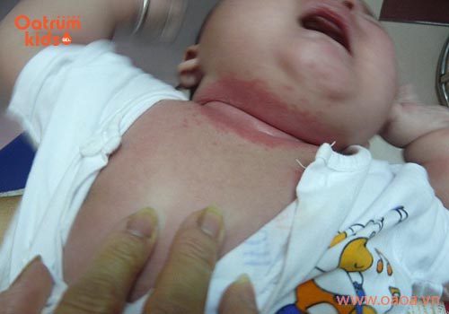 Trẻ bị nổi mẩn đỏ ở cổ và mông phải làm sao?