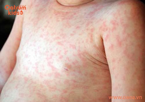 Trẻ mẩn ngứa khắp người sau khi sốt có đáng lo?
