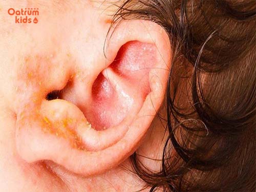 Trẻ sơ sinh bị chảy nước vàng ở tai là biểu hiện của bệnh gì?