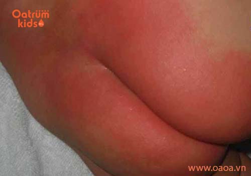 Trẻ sơ sinh bị nổi mẩn đỏ ở mông có phải bị hăm tã?