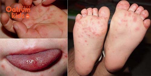 Triệu chứng bệnh tay chân miệng dễ nhận biết nhất