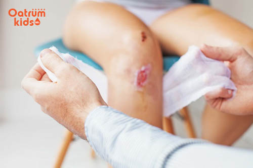 Vết trầy xước bị nhiễm trùng ở trẻ nên và không nên làm gì?